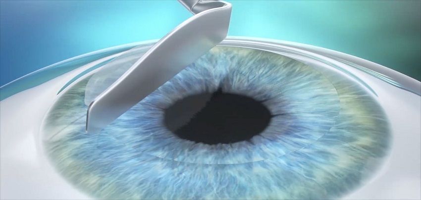 عمل لازک چشم از جمله جراحی های لیزری چشم است که مورد توجه زیادی قرار می گیرد - چیکاو
