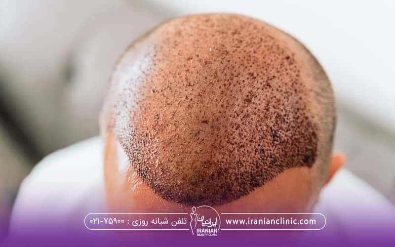عکس از بالا سر فردی که کاشت مو انجام داده است - کاشت مو