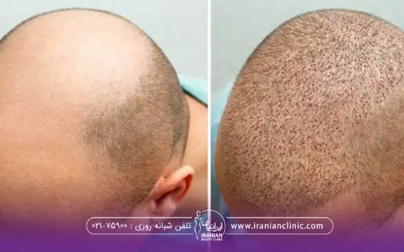 عکس قبل و بعد فردی که کاشت مو انجام داده است
